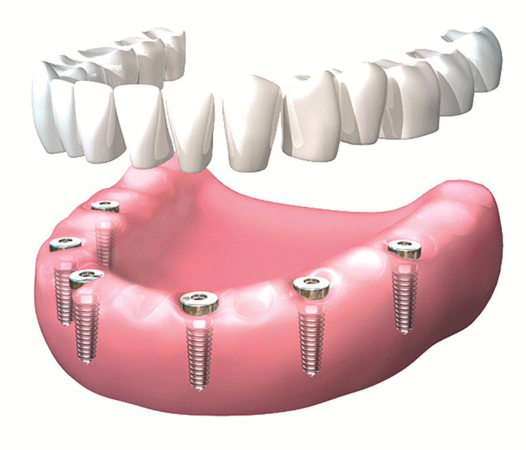 En implantologia també existeixen solucions senzilles i eficients com els mini implants